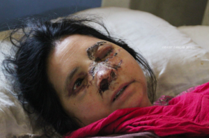 Injured Kashmiri woman (twitter of Basit Zargar) Sept 7 2016