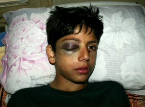Kashmiri boy with pellet injury Oct 4 2016