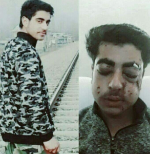 Suhail (15) hit by pellets in both eyes Mar 17th (from Twitter Irshad Nabi) Mar 22 2017