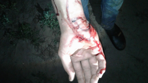 Injured hand