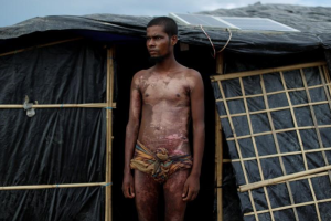 Mohamed Jabair, 21, shows burn injuries from Burma (Jorge Silva) Nov 18 2017