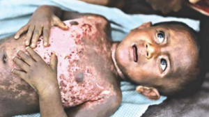 Rohingya child injured by Burmese or nationalist death squads Nov 25 2017