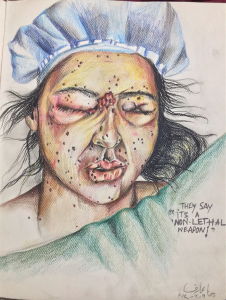 Pellet victim by Hina Arif