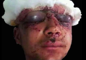 Kashmiri boy pellet gun victim